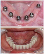 permanent dentures