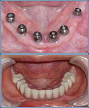 permanent dentures