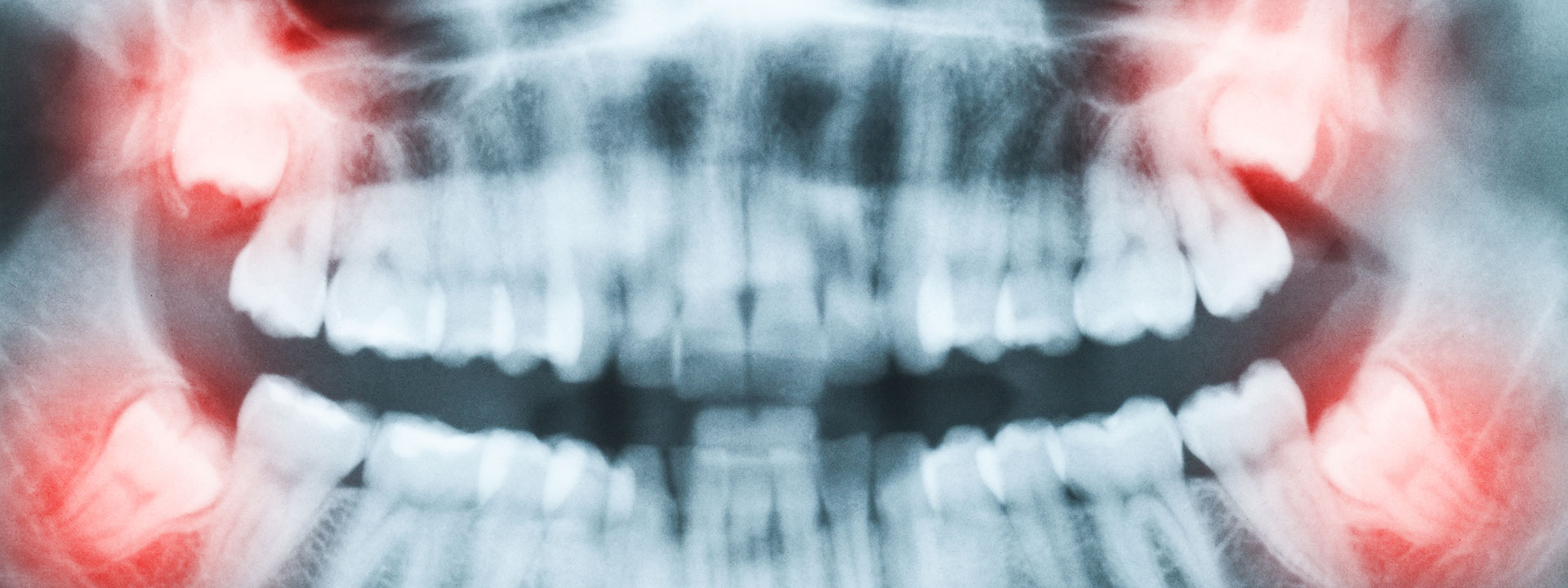 wisdom teeth xray